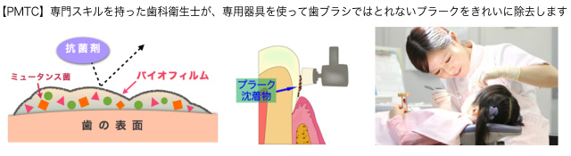 歯周病写真